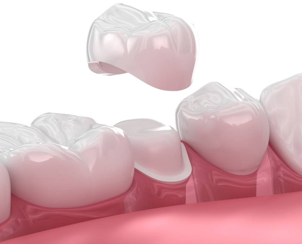 how much does it cost to reattach a crown​？